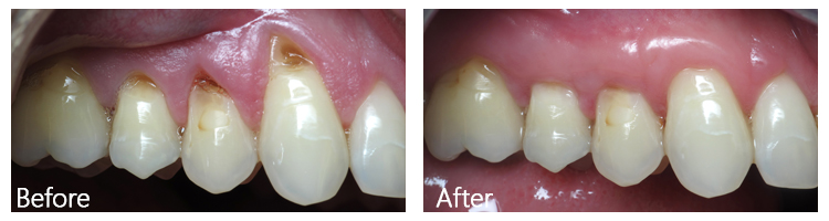 Gum recession soft tissue grafting
